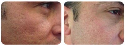 Microneedling (Cheeks)